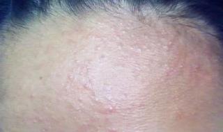 额头长痘痘了怎么办 额头长痘痘了怎么办