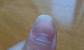 手指甲上有黑色竖纹